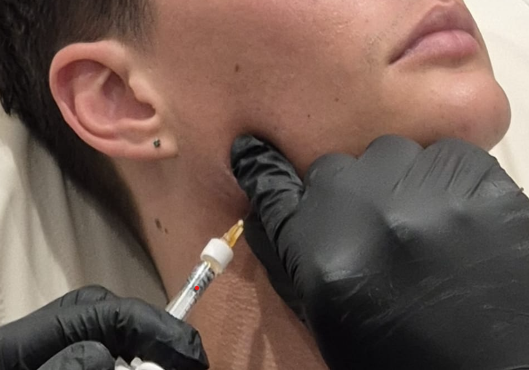 Jawline Contouring